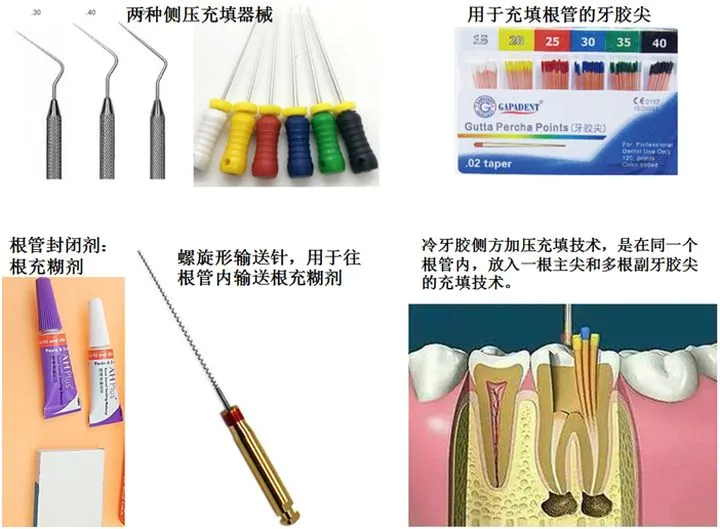 冷牙胶侧方加压根管充填技术和热牙胶垂直加压根管充填技术,这两种根